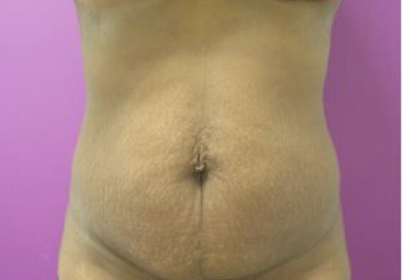 Tummy Tuck before and after - before