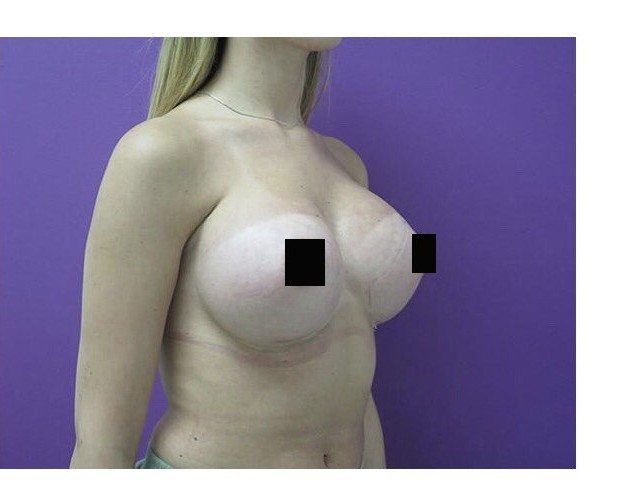 Breast Augmentation before and after - after