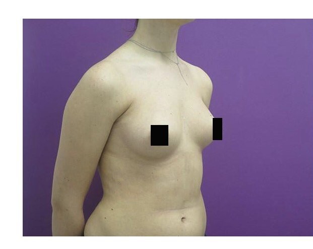 Breast Augmentation before and after - before