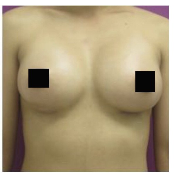 Breast Augmentation before and after - after