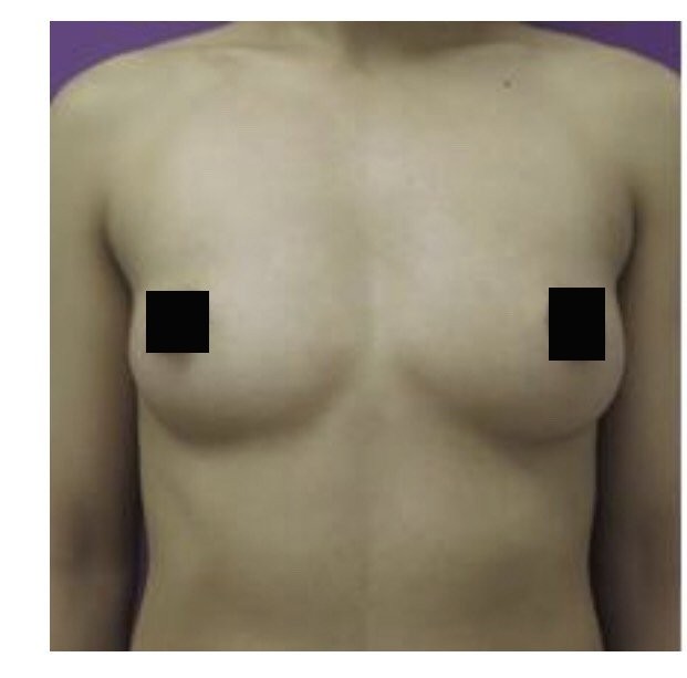 Breast Augmentation before and after - before
