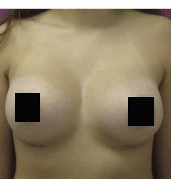 Breast Augmentation before and after - after