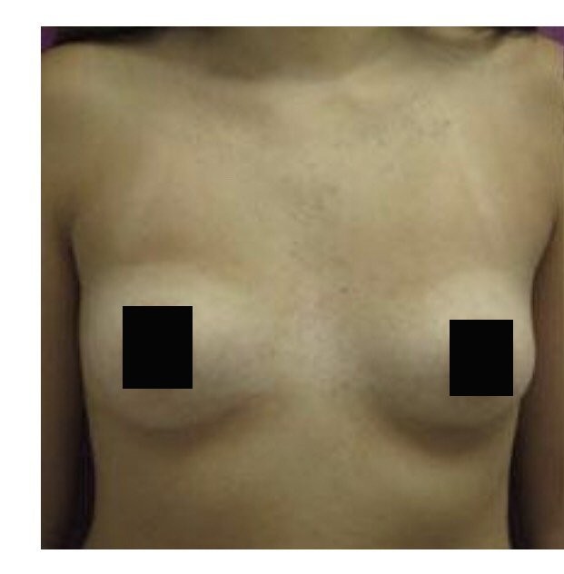 Breast Augmentation before and after - before