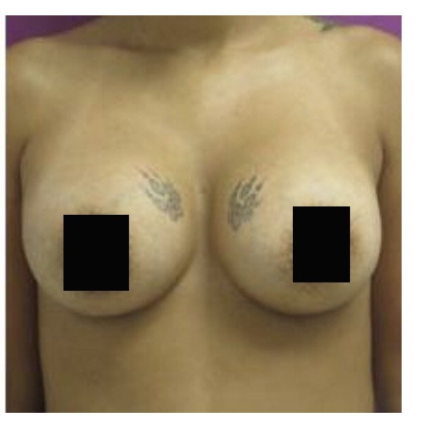 Breast Augmentation before and after - after