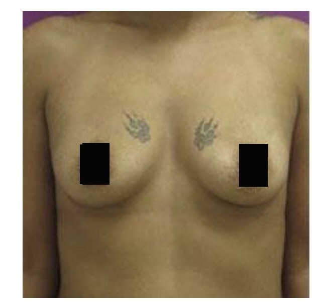 Breast Augmentation before and after - before
