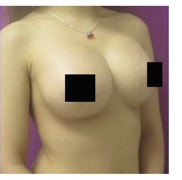 Breast Augmentation before and after - after