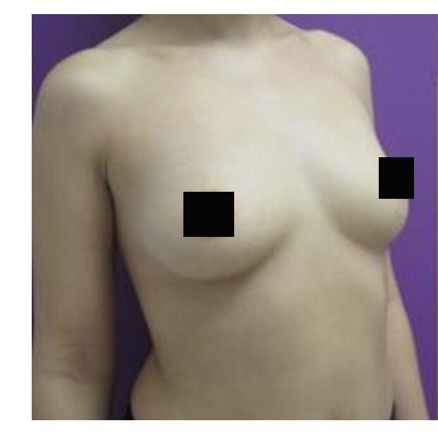 Breast Augmentation before and after - before