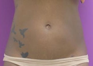Liposuction before and after - after