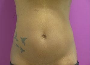 Liposuction before and after - before