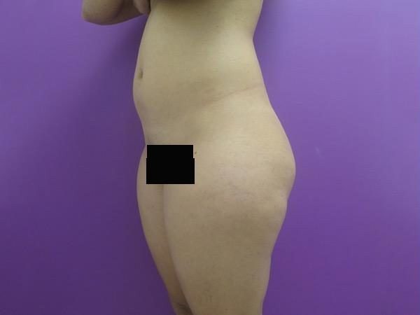 Liposuction before and after - before