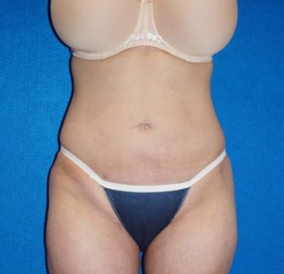 Liposuction before and after - after