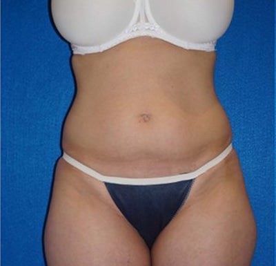 Liposuction before and after - before
