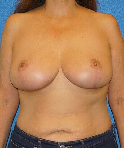 Breast Augmentation before and after - after