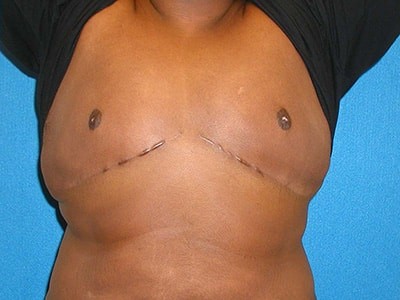 Breast Augmentation before and after - after