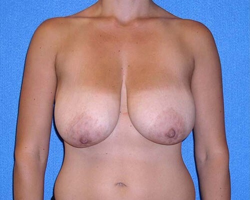 Breast Lift before and after - before