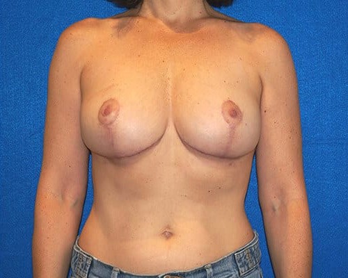 Breast Lift before and after - after