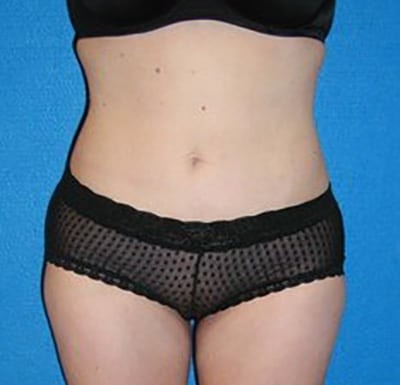Liposuction before and after - after