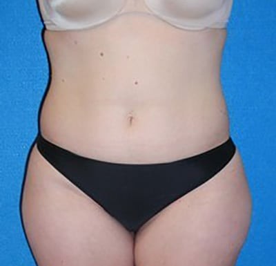 Liposuction before and after - before