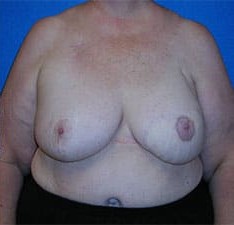 Breast Reconstruction before and after - after