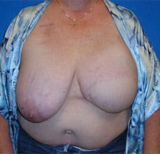 Breast Reconstruction before and after - before