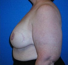 Breast Reconstruction before and after - after