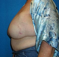 Breast Reconstruction before and after - before
