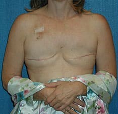 Breast Reconstruction before and after - before