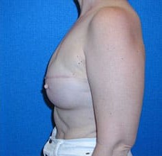 Breast Reconstruction before and after - after