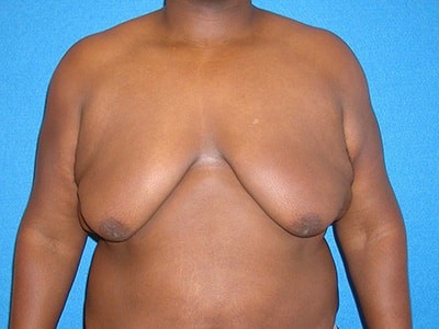 Gynecomastia Surgery before and after - before