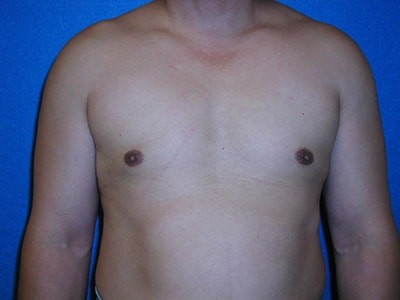 Gynecomastia Surgery before and after - after