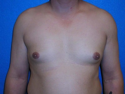 Gynecomastia Surgery before and after - before