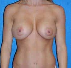 Liposuction before and after - after