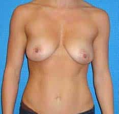Liposuction before and after - before