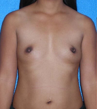Breast Augmentation before and after - before