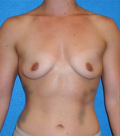 Breast Augmentation before and after - before