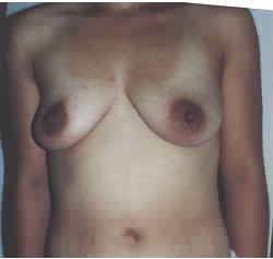 Breast Augmentation by Dr. Aaron Stone — before