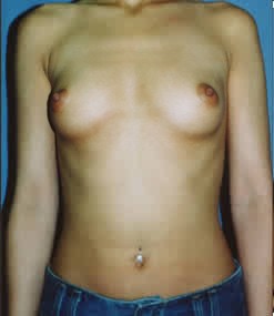 Breast Augmentation by Dr. Aaron Stone — before