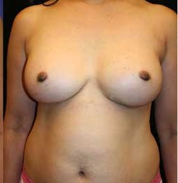 Breast Augmentation by Dr. Aaron Stone — after