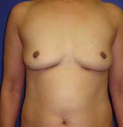 Breast Augmentation by Dr. Aaron Stone — before