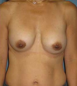 Breast Augmentation by Dr. Aaron Stone — after