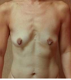 Breast Augmentation by Dr. Aaron Stone — before