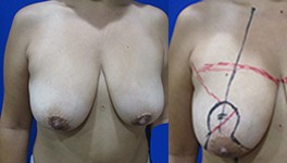 Breast Lift with Breast Augmentation by Dr. Aaron Stone — before