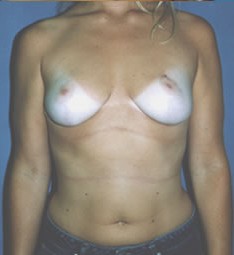 Breast Reduction by Dr. Aaron Stone — after