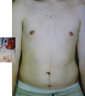 Gynecomastia Excision by Dr. Aaron Stone — after