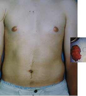Gynecomastia Excision by Dr. Aaron Stone — before