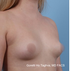 Fat Transfer to Breast before and after - before