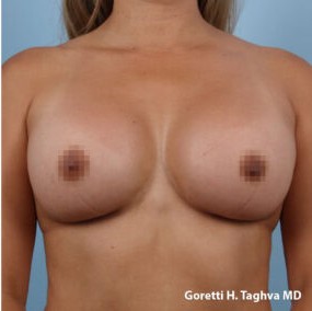 Breast Augmentation before and after - after