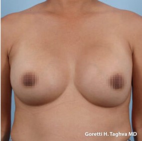 Breast Augmentation before and after - after