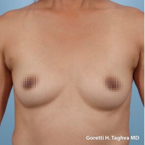Breast Augmentation before and after - before