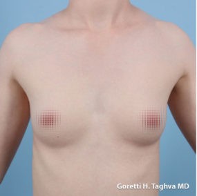 Breast Augmentation before and after - before